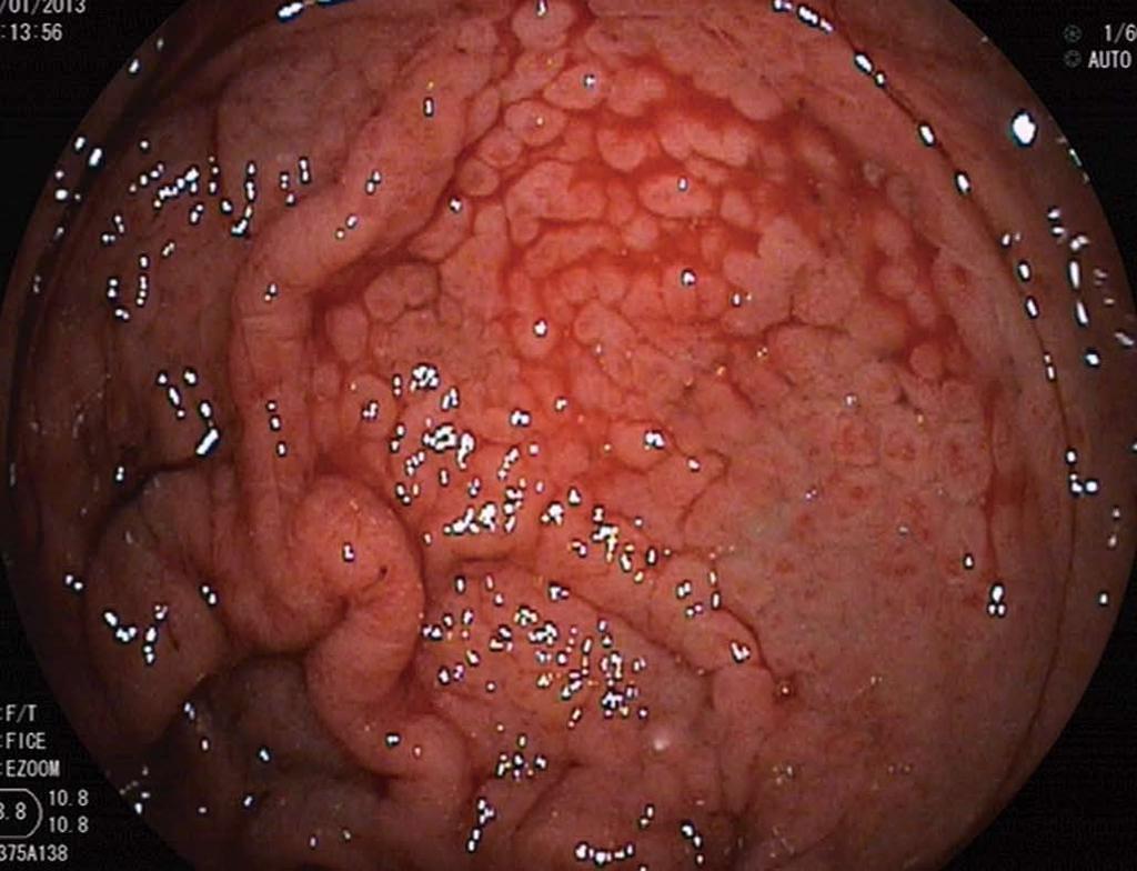 Figure 4 Acute diffuse bleeding from portal hypertensive gastropathy in a patient with decompensated liver cirrhosis.