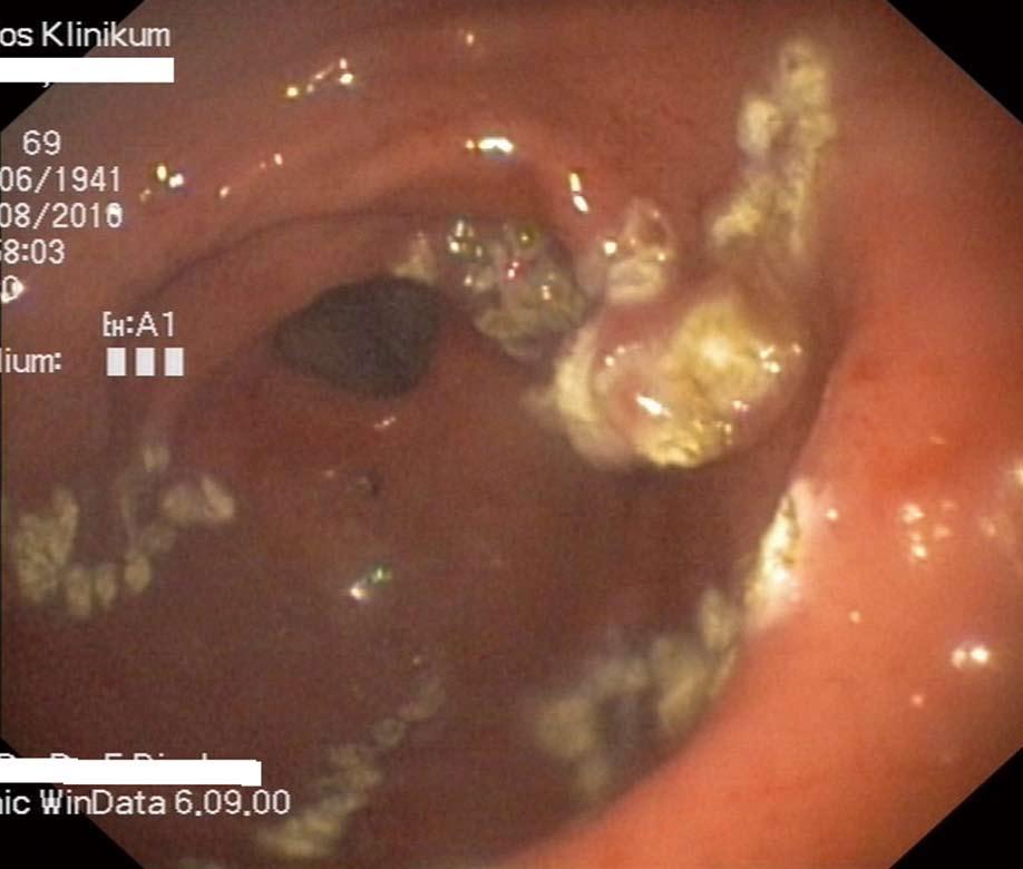 Colonoscopy is the principal method for the diagnosis of colonic varices.