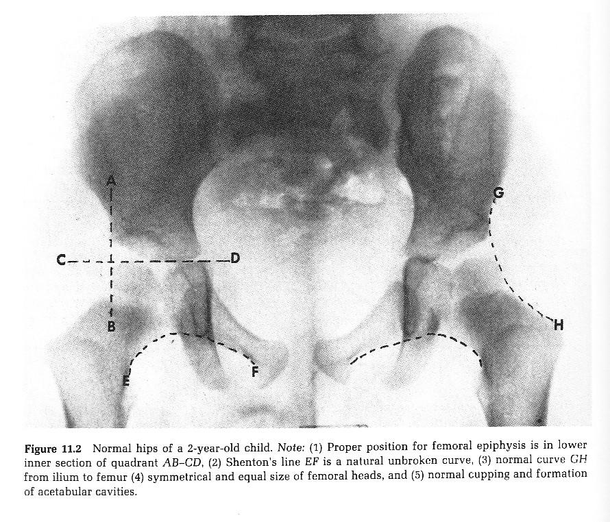3 Diagnostics Tax (1980:pp156-157) When clinical examination highlights the likelihood of this condition it is further checked with x-ray or ultrasound to confirm diagnosis.