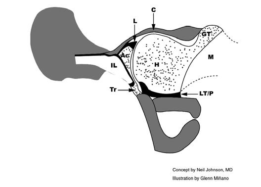 clinical examination of the hip (Barlow and Ortolani tests) and assess femoral stability. If the femoral head is subluxable or dislocatable, reducibility can be assessed.