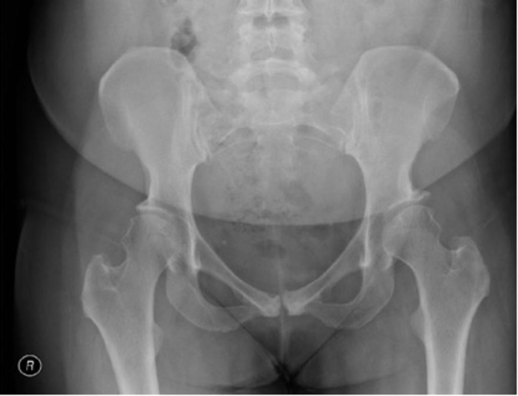 Fig. 2: Figure 2 - AP pelvis radiograph showing bilateral aspherical and flattened femoral heads.