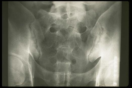 General Introduction This delay in diagnosis might be explained by the nonspecific, insidious symptoms of low back pain at the onset of the disease. Figure 1: Sacroiliitis (grade 2, bilateral).
