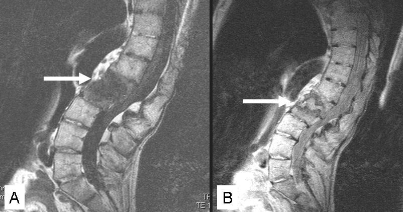 Chapter 6.1 Figure 4: T1-weighted sagittal MRI of a 74-year old AS patient showing an AL at the L1-L2 level with characteristically reduced signal intensity.