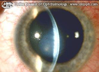 Herpes Zoster Ophthalmicus Sight-threatening complications