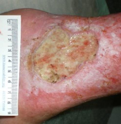 Venous Ulceration Venous ulcers are more commonly found above the medial or lateral malleoli