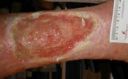 Leg Ulcers - What are the causes?