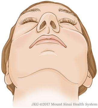 558 Lozada et al. Operative techniques described in the literature strive to restore basic form and function of the midface while preventing the initial complications from becoming long-standing.