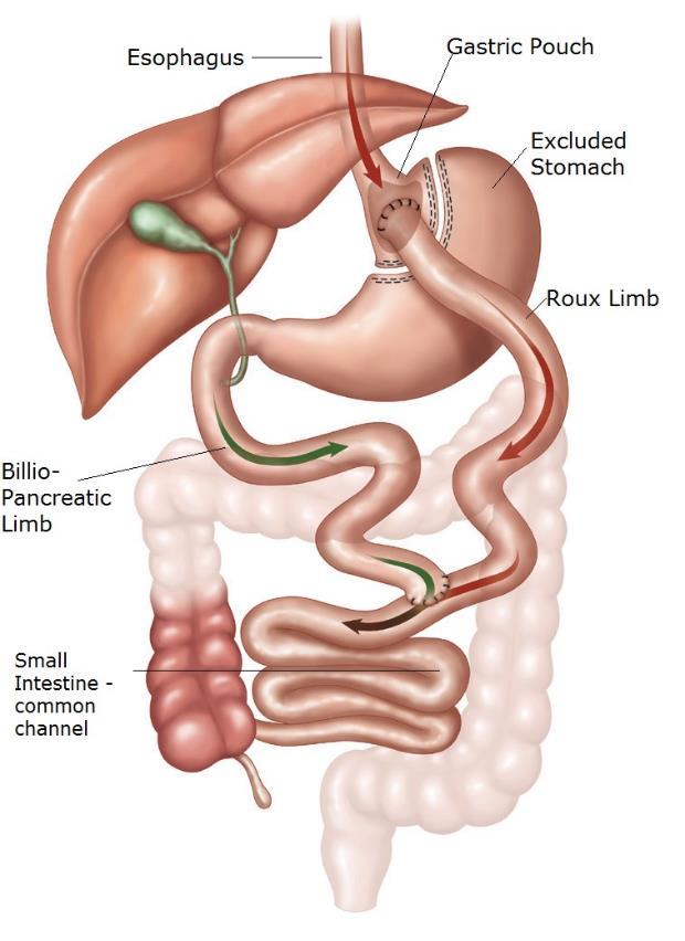 Gastric Roux-en-Y bypass (RYGB) surgery in detail http://www.