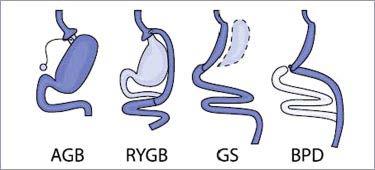 Diagram of common surgical options in Bariatric Surgery 1,2 Different procedures require different post-operative supplementation regimes AGB - Adjustable gastric banding GS - gastric sleeve RYGB -