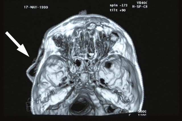 Coronal scan showing gross comminution of zygomaticomaxillary buttress (large arrow).