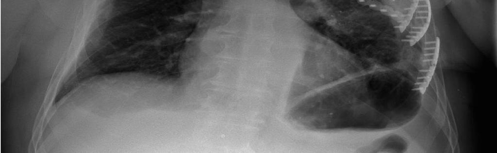 low chylous flow while the thoracic duct stump healed