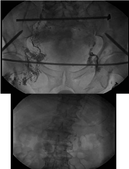 7/29 IR Lymphangiogram Lymphangiography was performed to locate chylous leak in the chest and attempt to perform Cisterna Chyli/thoracic duct scarification.