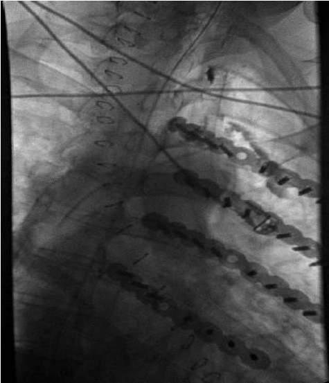 Injected left groin, again, contrast became irregular at the rod, and was unable to enter the iliac nodes Minimal contrast accumulation in left para aortic nodes. After 2.