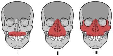 + Le Fort Fractures Classical description of all Le Fort fractures are bilateral and