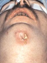indicate orbital fracture TMJ and