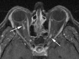 Traumatic Optic Neuropathy Secondary acute trauma (Assault, MVC): demyelinating, inflammatory, ischemic causes Direct or indirect axon damage Impaired -- to loss of vision Avulsion, hemorrhage,