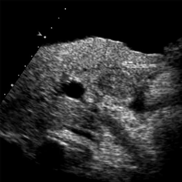 Kim TK et al. CEUS in diagnosis of nodules A B C Figure 1 A 61-year-old man with hepatocellular carcinoma and renal failure.