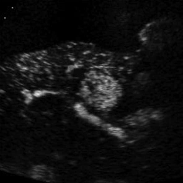 Contrast-enhanced computed tomography or magnetic resonance scan could not be performed because of renal failure; B: Contrast-enhanced ultrasound (CEUS) image in the arterial phase shows