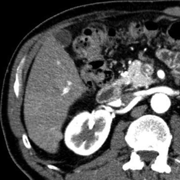 Kim TK et al. CEUS in diagnosis of nodules A B Figure 2 A 63-year-old man with moderately-differentiated hepatocellular carcinoma.