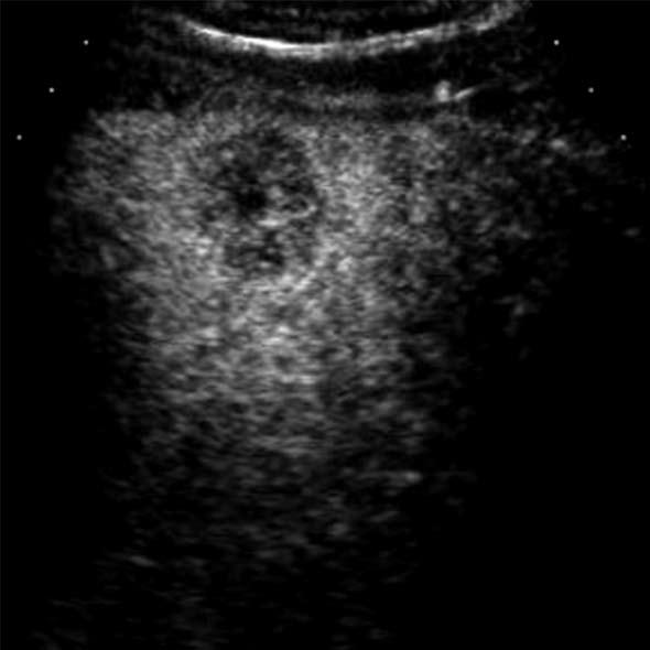 A: Gray-scale ultrasound shows an exophytic hypoechoic mass in the liver; B: The mass (arrows) is hypoechoic relative to the adjacent liver in the arterial phase of contrast-enhanced ultrasound; C: