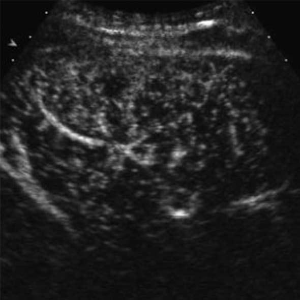 contrast-enhanced ultrasound; C: The nodule is isoechoic to the liver in the portal venous phase. Biopsy revealed low-grade dysplastic nodule.