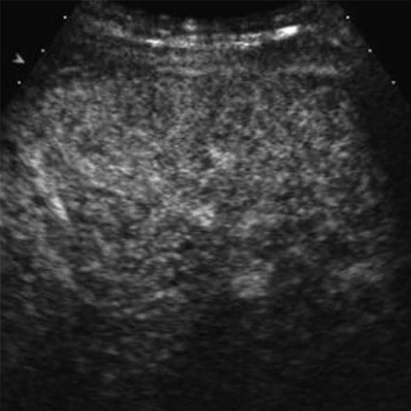 A: Grayscale ultrasound shows a hypoechoic nodule (arrow) in the subcapsular portion of the liver; B: There is a peripheral strong hyperenhancement (arrows) in the arterial phase of