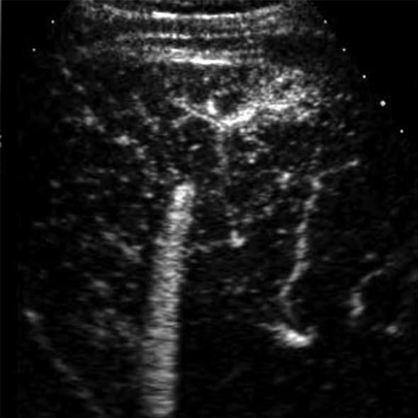 portal venous phase due to isoechogenicity to the liver. A B Figure 8 A 70-year-old man with recurrent hepatocellular carcinoma after radiofrequency ablation.