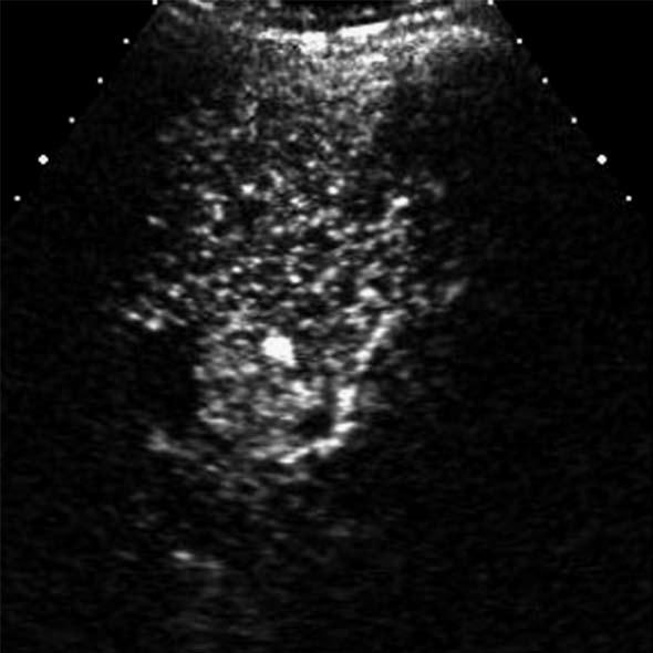 arterial phase of contrast-enhanced ultrasound; C: The thrombus (arrows) is hypoechoic relative to the liver in the portal venous phase. lesion.