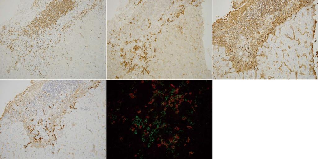 Kobayashi M et al. AIH and PBC with interface hepatitis A B C D E BD * Figure 3 Immunohistochemical findings of primary biliary cirrhosis with interface hepatitis.