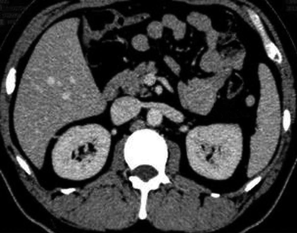angle of Treitz before (C) and after (D) chemotherapy (arrow). in 3 cases, and high in 3 cases. All 13 patients underwent computed tomography (CT) examination.