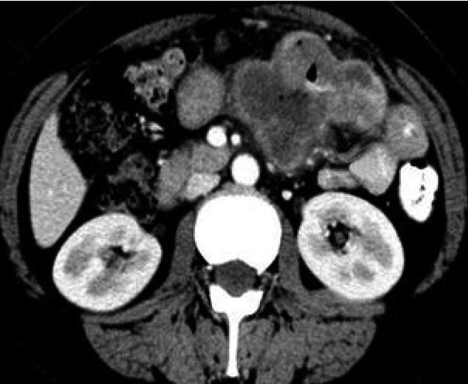 The other patient with adenocarcinoma survived and showed no recurrence at the 18-mo follow-up.