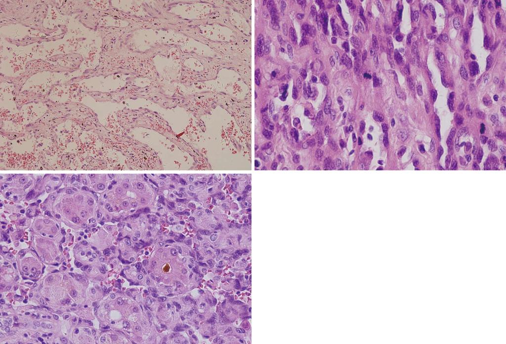 Wang ZB et al. ERG and hepatic angiosarcoma diagnosis A B C Figure 3 Analysis of hepatic angiosarcoma histology with hematoxylin and eosin staining.