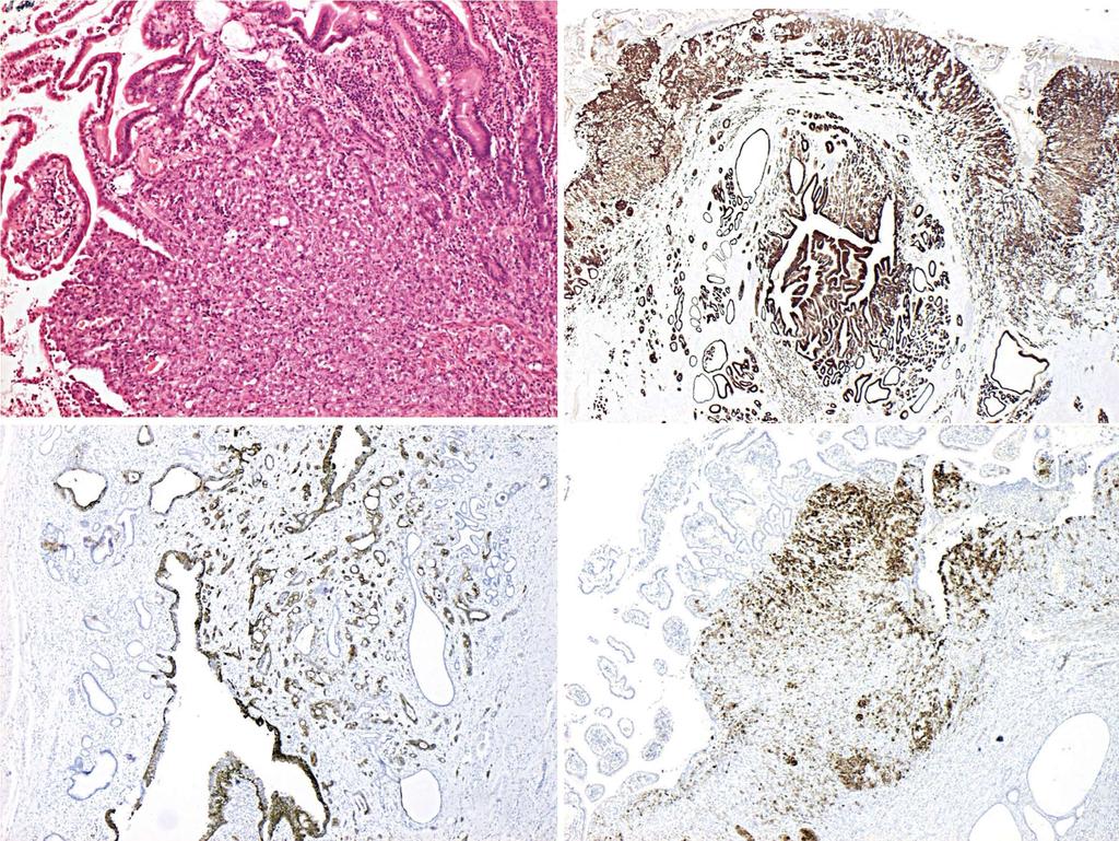 Ejtehadi F et al. Coloanal metastases from pancreato-biliary cancers A CK7 CK17 MUC1 B CK7 MUC1 CK17 Figure 1 Immunohistochemical staining.