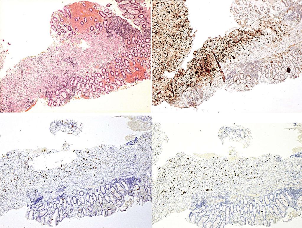 CDX2/mucin-2 (CK20/CDX2/MUC2) negative; B: Immunohistochemical staining of the anal fissure biopsy demonstrating pancreato-biliary phenotype similar to the ampullary adenocarcinoma.