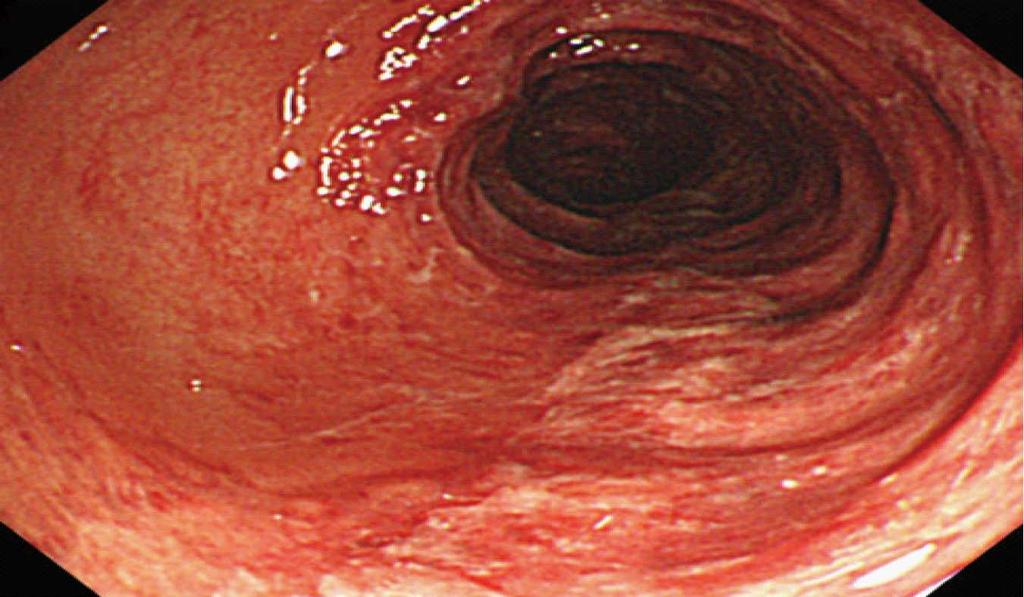 computed tomography findings. The results shows submucosal edematous changes and decreased enhancement of thickened colonic wall from the ascending colon to the distal transverse colon.