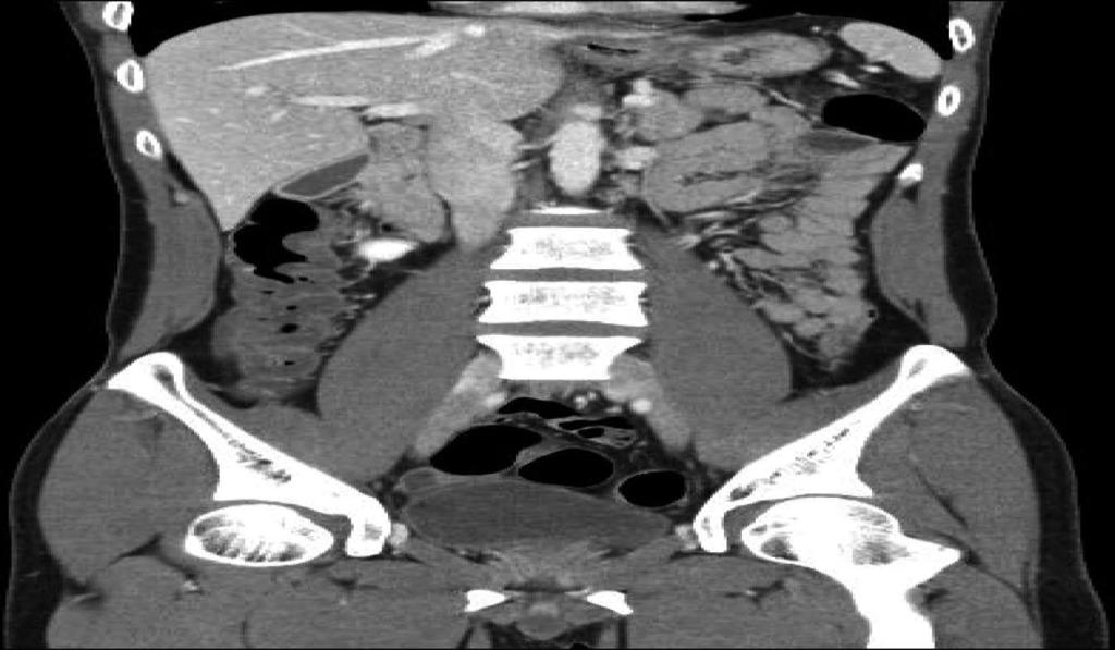 Case 2 A 40-year-old man presented to the emergency room complaining of hematochezia with diffuse abdominal pain 18 hours after a routine screening colonoscopy in the primary clinic.