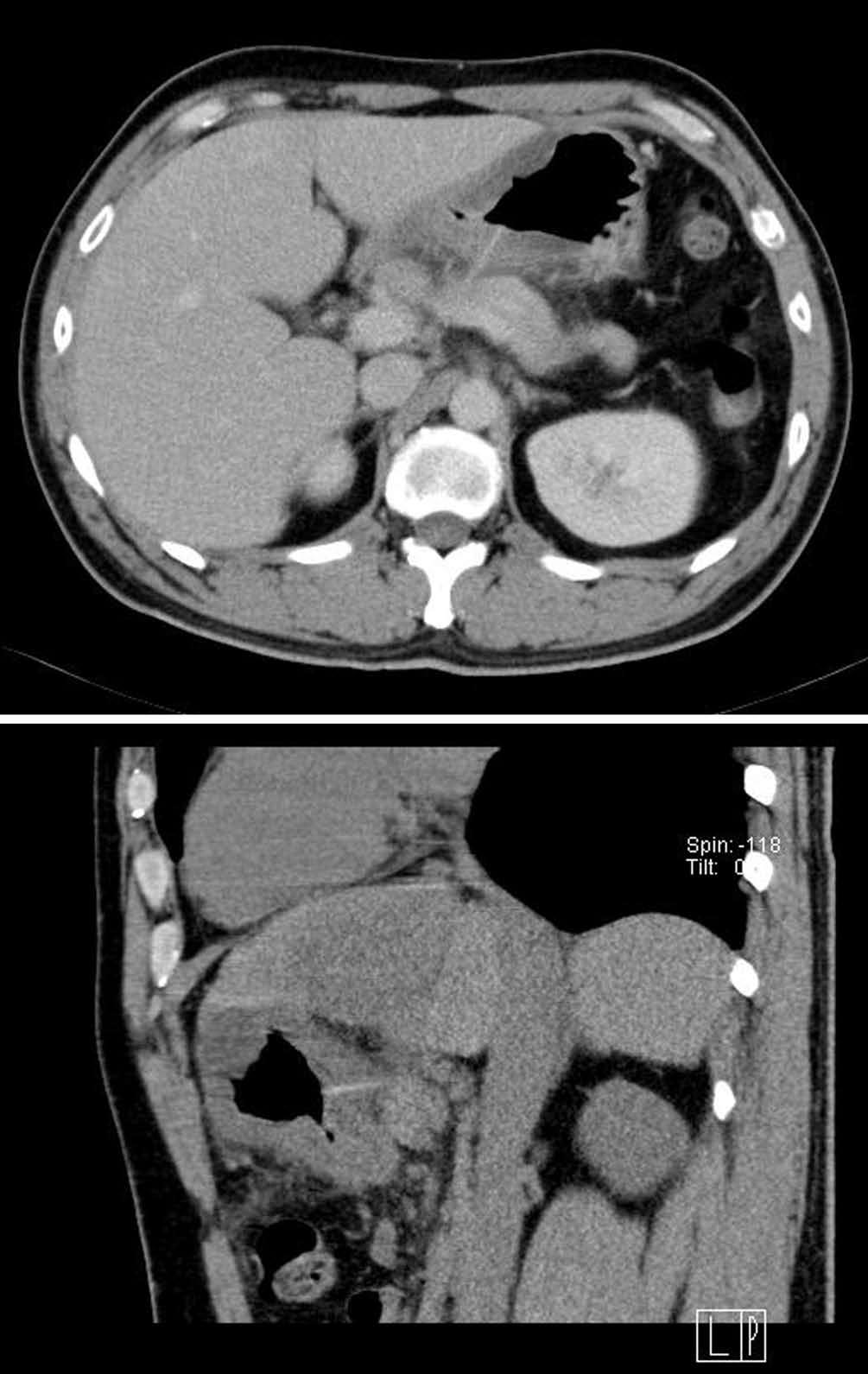 Chong LW et al. Penetrating gastrointestinal foreign body-induced hepatic abscess A A B B Figure 1 Imaging studies with contrast-enhanced computed tomography scan.