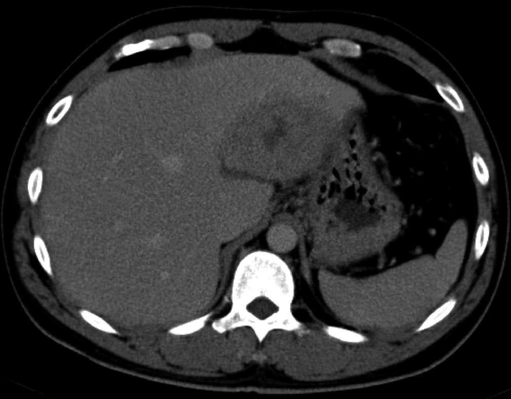 reformation image demonstrating close contact of the foreign body to the pancreas without evidence of vascular injury (arrow). Figure 2 Liver abscess demonstrated in imaging study.