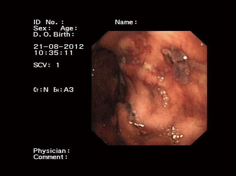 Zhou HB. Hemobilia by percutaneous ultrasound-guided liver biopsy A B Figure 1 Magnetic resonance cholangiopancreatography.