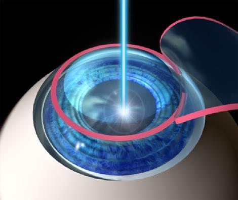 Causes of Dry Eye Symptoms Iatragenic Causes Refractive surgery