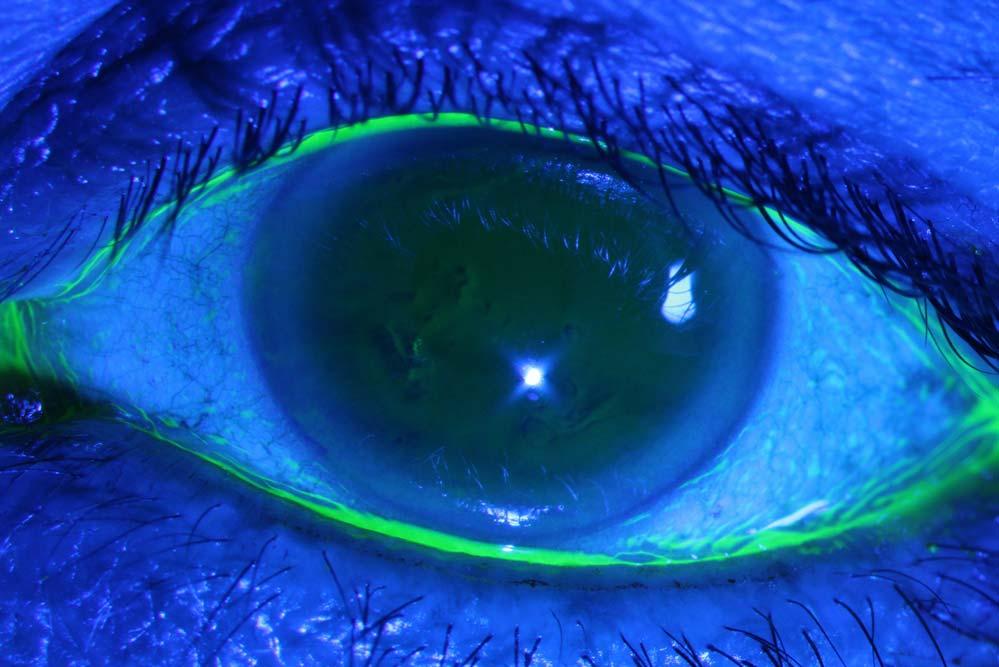 Conjunctivochalasis Impact on Dry Eye IOVS j May 2015 j Vol. 56 j No. 5 j 2868 istration Ophthalmology Clinic between October 2013 and October 2014.