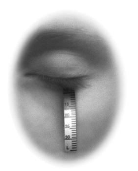 CD 920141 Pupil Expander opens to an ample 6.3mm Only 1 minimal 2.75mm incision required Less traumatic for the iris sphincter Supplied: 1 gauge per package.