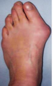 What is hallux valgus? The big toe of the foot is called the hallux.