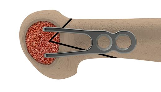 Alternative Surgical Technique - Other Osteotomies With planning, the Re+Line Bunion Correction Plate can be used with other osteotomies, including Long Arm Chevrons, Reverdin Laird, Large Correction
