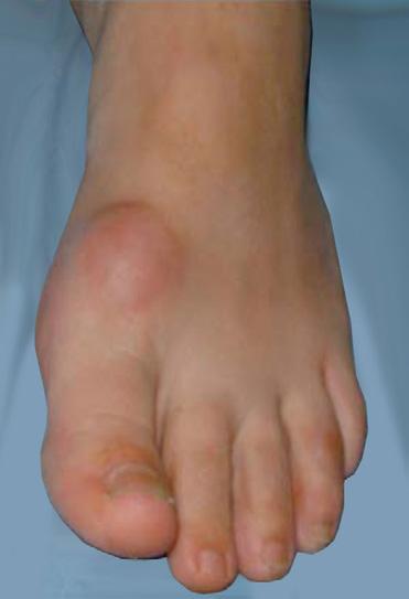 Hard skin and calluses can form around the big toe and under the ball of the foot which in turn can be uncomfortable.