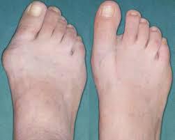 Arthritis - If your big toe joint has significant arthritis, we may recommend surgery to fuse the toe joint together.