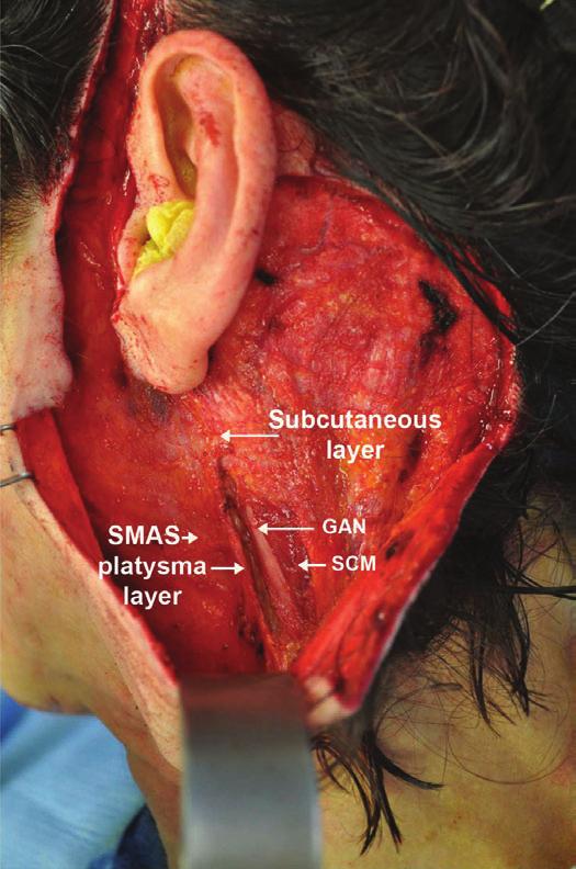 22 Aesthetic Surgery Journal 33(1) Figure 6. Anchoring of the superficial musculoaponeurotic system (SMAS) platysma layer to a safer zone posterior to the great auricular nerve.