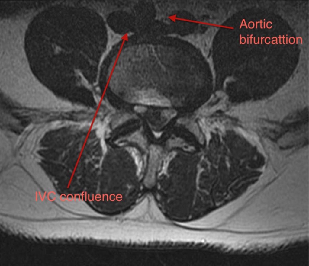 Fig. 1: IVC confluence and