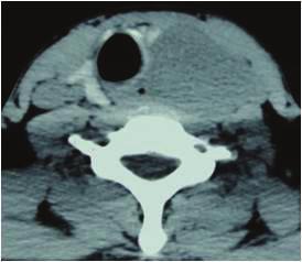 Case Reports in Otolaryngology 3 (a) (b) (c) (d) (e) (f) Figure 2: Plain (a) and contrast (b) axial images of computed tomography (CT) revealing isodense nonenhancing neck swelling.