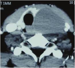 On T2 weighted axial image, the lesion had a small beak-like extension ((black arrow in (f)). cyst [3].